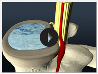 Effects of Flexion-Distraction Therapy on the lumbar spine - video
