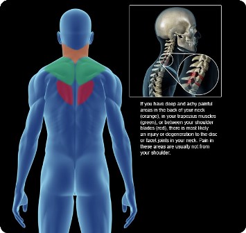 Bulging Disc in Neck Referral Pattern